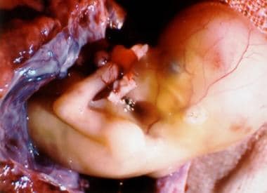 A 12-week interstitial gestation, which eventually