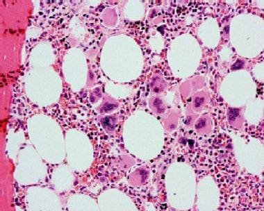Bone marrow biopsy in essential thrombocytosis sho