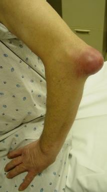 Infectious bursitis. Image courtesy of Christopher