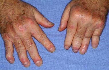 Severe psoriatic arthritis showing involvement of 