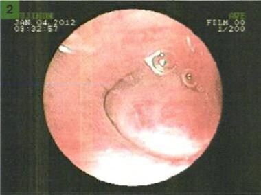 Bronchoscopy: Carcinoid tumor (Left Lower Lobe - A