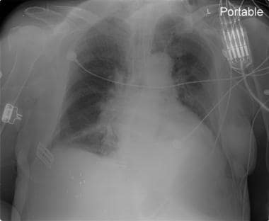 Neurogenic pulmonary edema in a patient with a sub