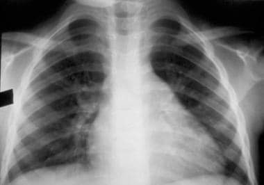 Chest radiograph showing cardiomegaly due to cardi