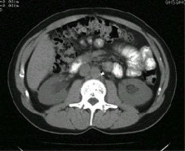 双侧肾积水的CT扫描