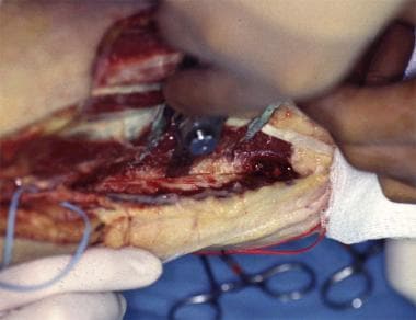 The horizontal osteotomy is performed using the os