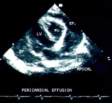 Two-dimensional echocardiograph shows a large peri