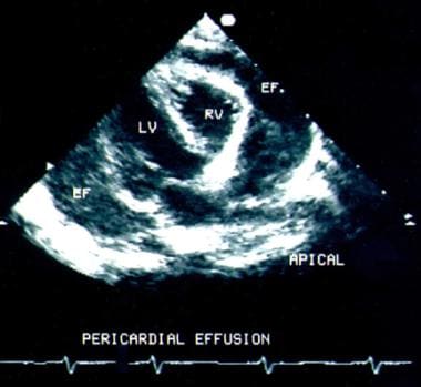 trivial pericardial effusion