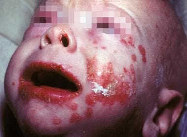 zinc deficiency acrodermatitis enteropathica