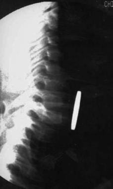 Lateral radiograph of impacted esophageal coin in 