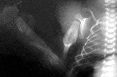 Acute fractures are observed in the radius and uln