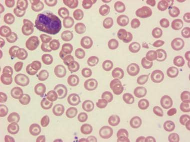 Blood smear of hemoglobin C trait. Note numerous t