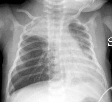 A chest radiography revealing lung hyperinflation 