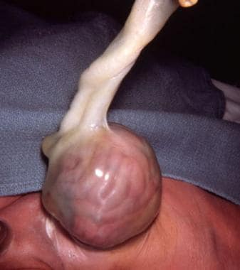 Pediatric omphalocele and gastroschisis (abdominal