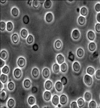 Hematuria: Practice Essentials, Background, Pathophysiology