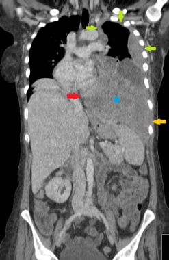 Coronal reformat from staging CT scan of a 70-year