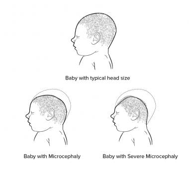 Illustration of typical head size, Microcephaly, a