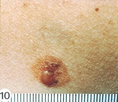 Dysplastic Nevus