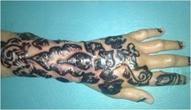 Bullous eczema allergic reaction to a henna skin d