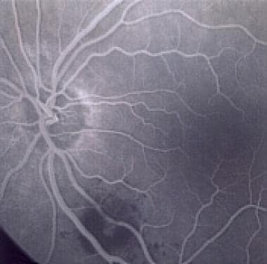 Fluorescein angiogram during the venous phase demo