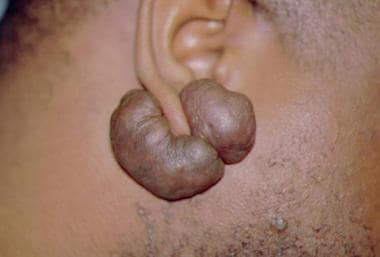 Ear lobe keloid scar from piercing. 