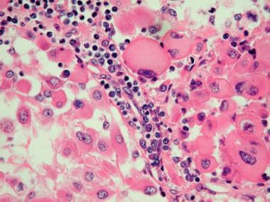 Rhabdoid renal cell carcinoma showing large pleomo
