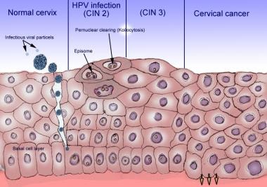 人乳头瘤病毒感染上皮细胞。