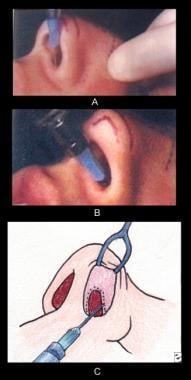 Anesthesia for tip surgery. (A) The area of the ba