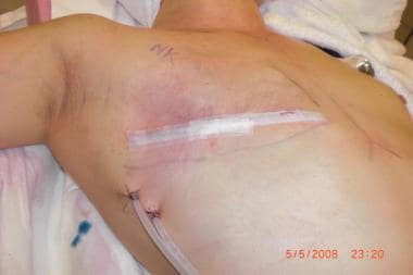 Drain placement and skin closing after mastectomy.
