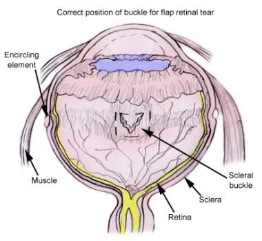 Placement of buckling material beneath retinal bre
