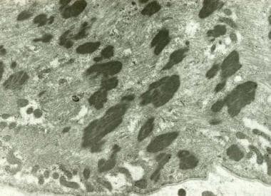 Nemaline myopathy, electron micrograph. Many elect