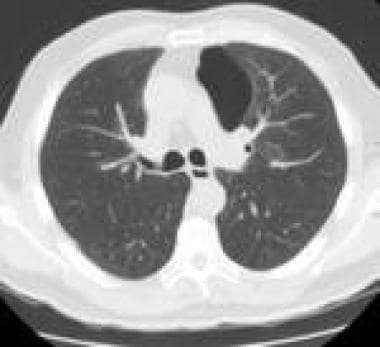 Computed tomography scan of chest showing bulla in