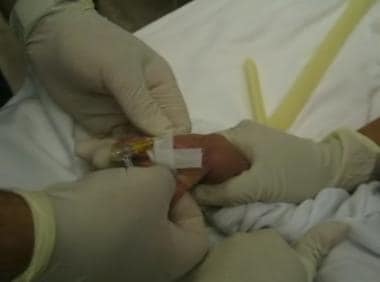 Securing pediatric venous access device. 