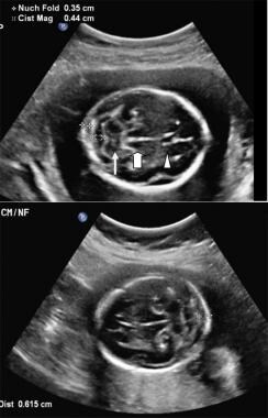 A (top image): Normal nuchal fold and cisterna mag