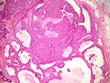 atypical ductal hyperplasia and papilloma
