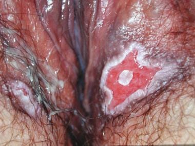Benign vulvar lesions. Pemphigus vulgaris, vulvar 