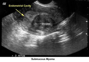 Infertility. Submucous myoma. Image courtesy of Ja