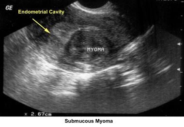 不孕。黏膜下肌瘤。图片由Ja提供
