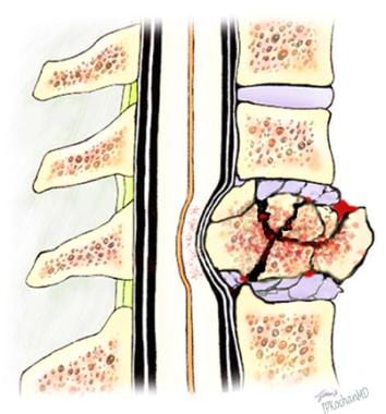 Compression Fracture: How it happens- what is it? 