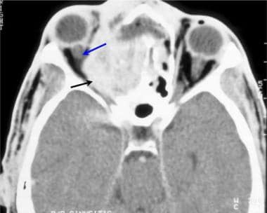 Brain abscess. Axial CT scan with intravenous (IV)