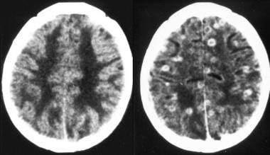 Nonenhanced (left) and enhanced (right) CT scans o