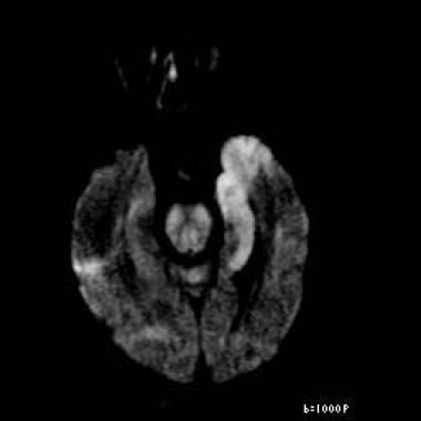 Axial diffusion-weighted image reveals restricted 
