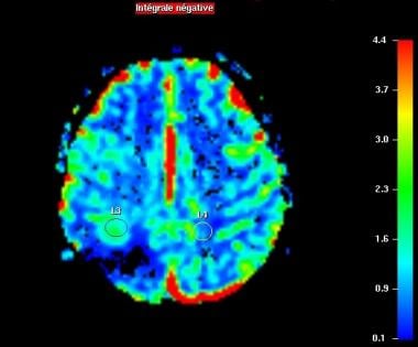 Perfusion-weighted imaging. Relative CBV map. Incr