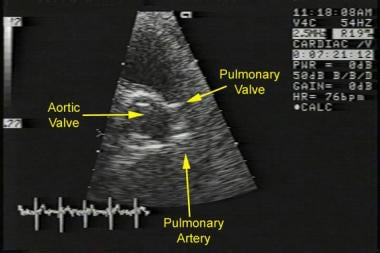 Pulmonic stenosis. Echocardiogram of a patient wit