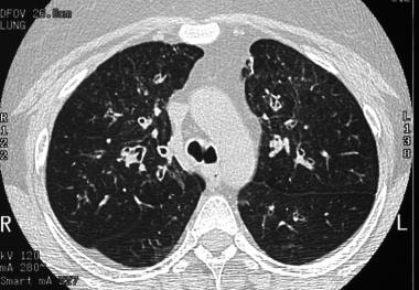 Asthma. High-resolution CT scan of the thorax demo