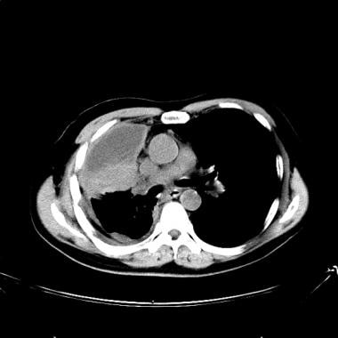 Lung cancer, small cell. CT scan of the chest at t