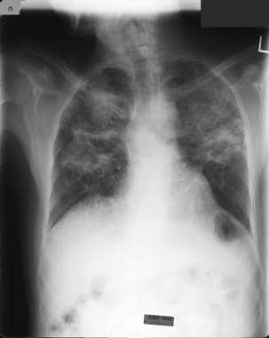 Silicosis with progressive massive fibrosis. Image