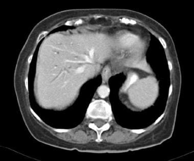 Dilated intrahepatic biliary tree without presence