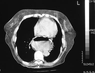 An axial CT scan of the thorax in a 75-year-old wo