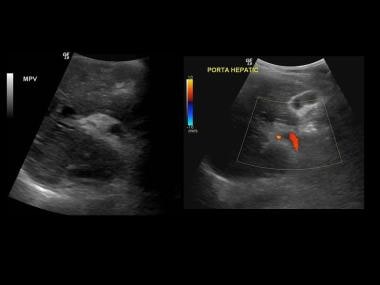 Ultrasound reveals an echogenic partially recanali