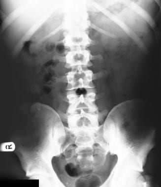 平原腹部x光照片。病人呈现